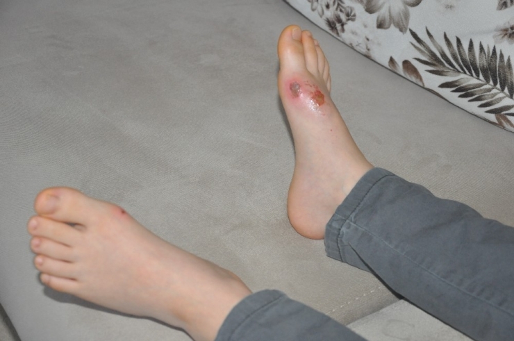 Vücudunda Yanık Oluşan Öğrencinin Babası Konuştu