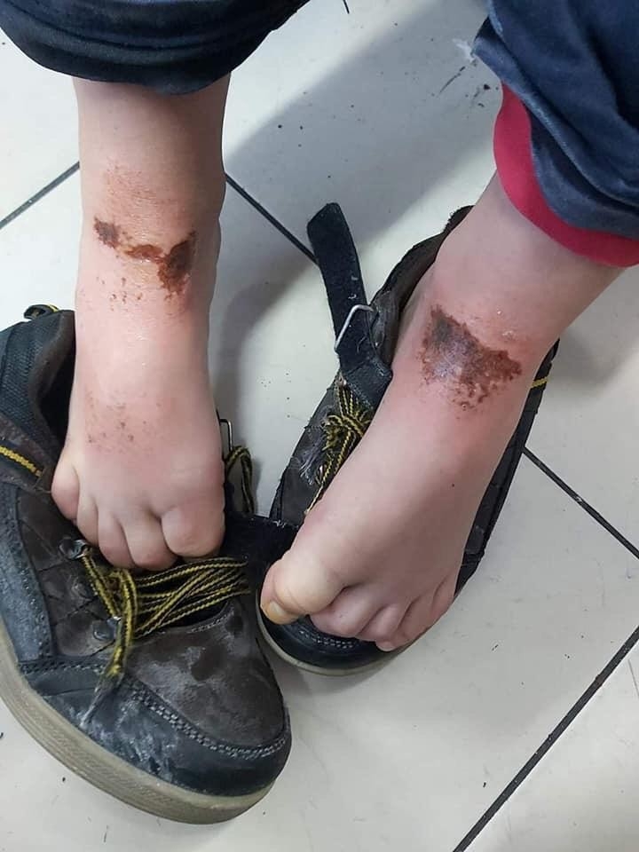 Kartopu Oynarken Vücutlarında Yanık Oluşan 2 Öğrencinin Tedavisi Sürüyor