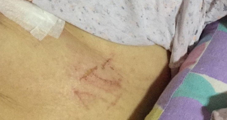 Denizli’de Yatalak Als Hastasının Karnına Tırnakla ‘Att’ Yazıldı İddiası