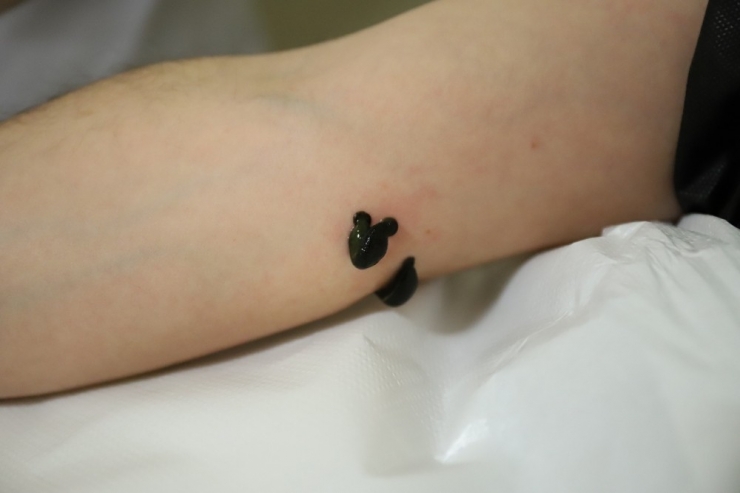 Varis Ve Eklem Ağrılarına Sülük Tedavisi