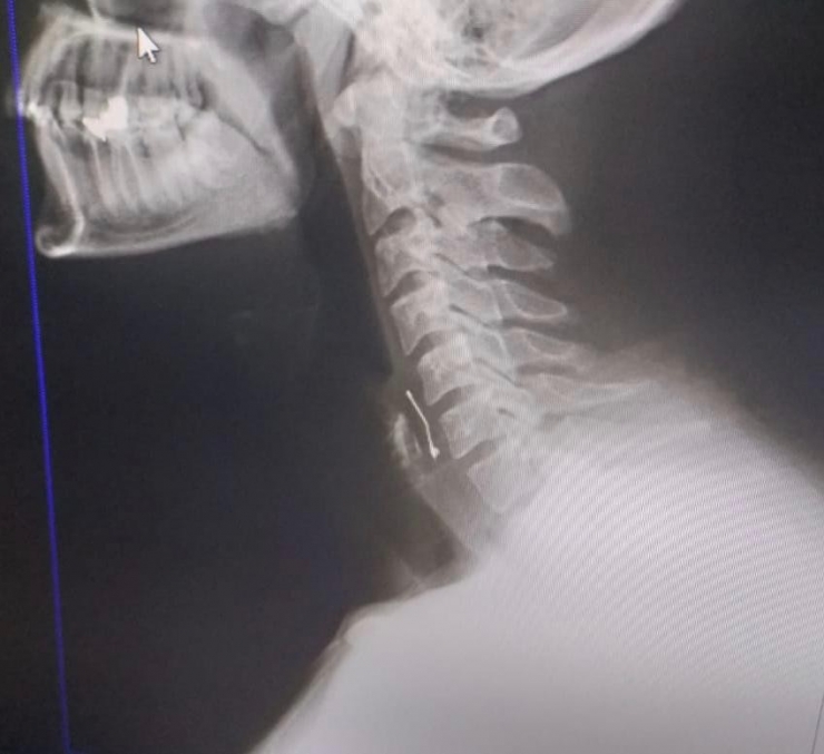 Doğum Günü Pastası Yerken Boğazına Toplu İğne Saplandı