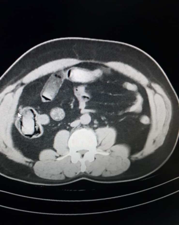 İranlı Yolcuların Midesinden Eroin Çıktı