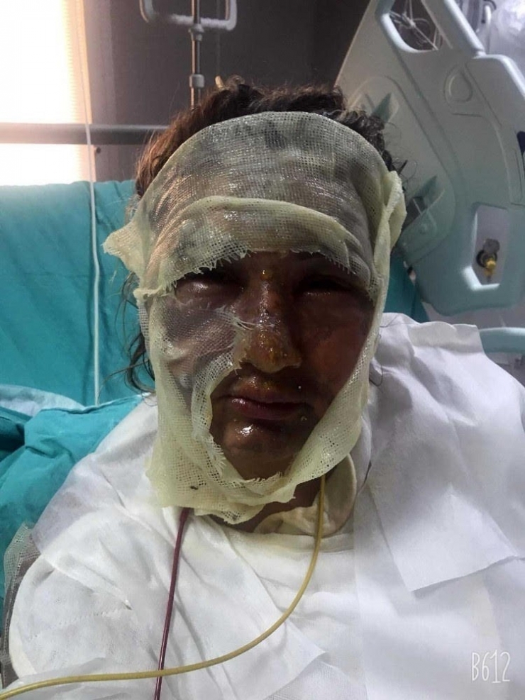 ’Yüzüme Kızgın Yağ Attı’ Demişti, İlk Duruşmada İfade Değiştirdi