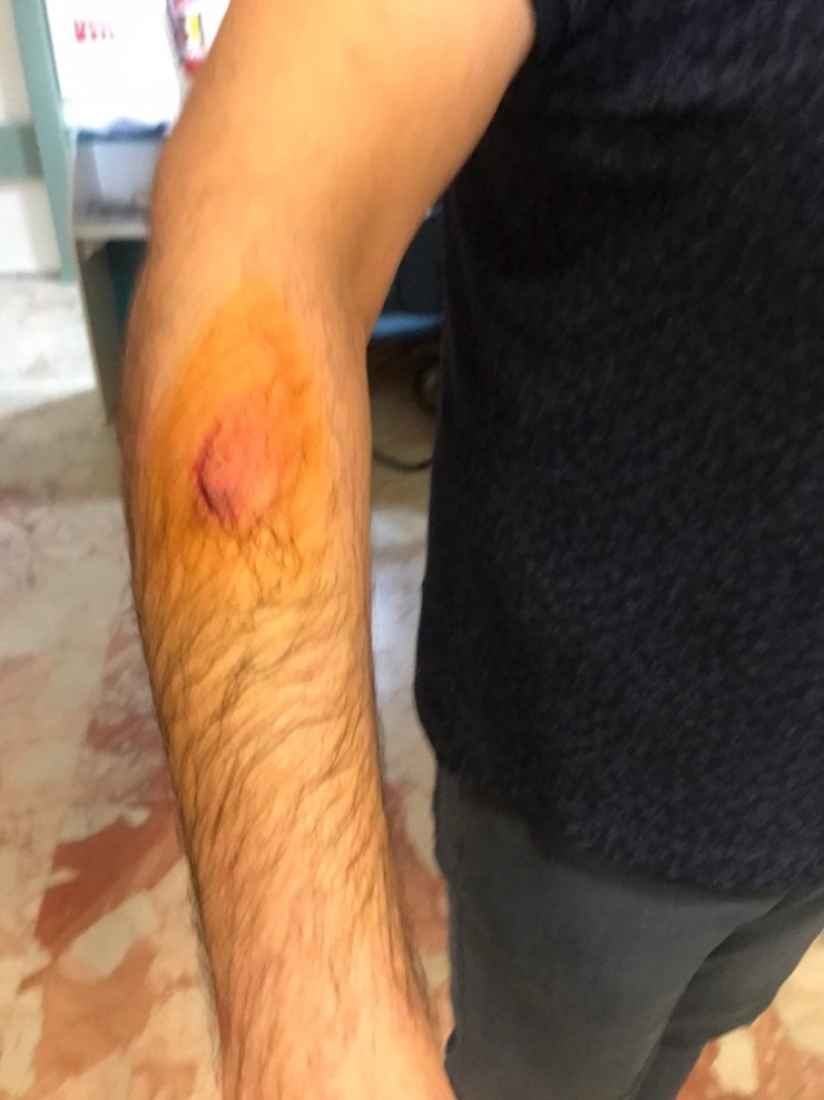 Hasta Yakını, Sağlık Çalışanını Isırıp, Darp Etti