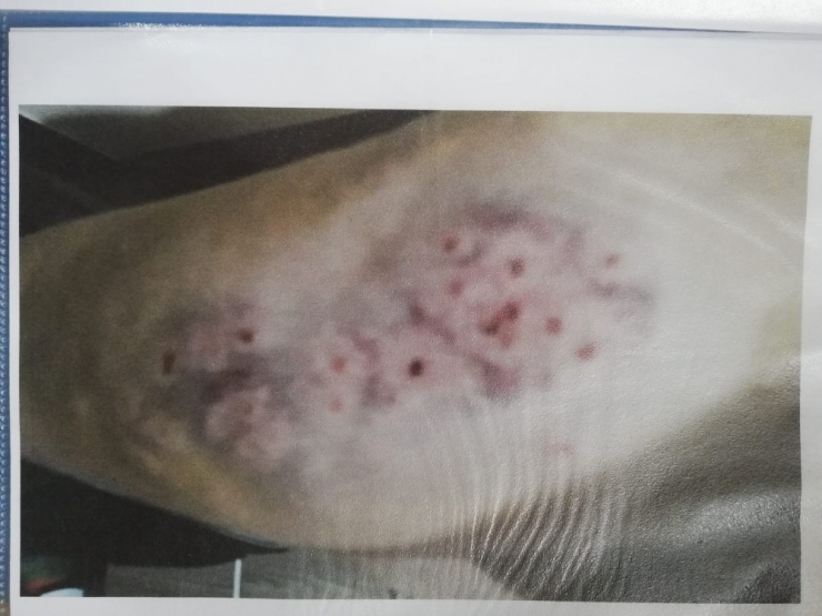 Otizmli Kıza Rehabilitasyon Merkezinde Darp İddiası